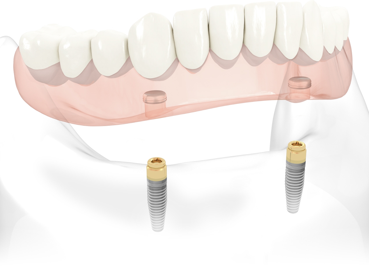 dental implants informative diagram